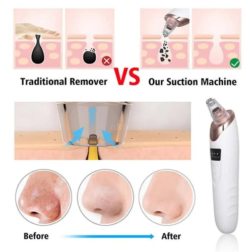 Blackhead Remover Vacuum – Deep Pore Cleaner with 4 Suction Heads